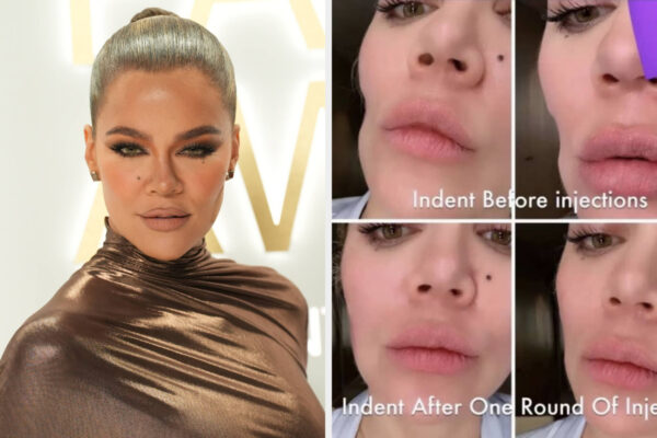 khloe-kardashian-showed-off-the-result-of-her-facial-filler-after-evening-out-an-“indentation”-in-her-cheek-from-getting-a-tumor-removed