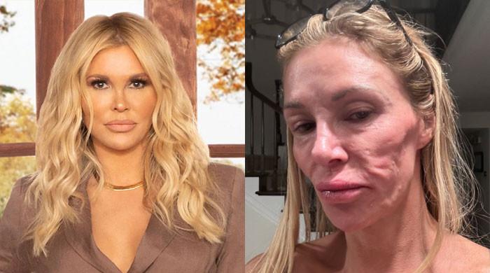 brandi-glanville-reveals-reason-behind-her-shocking-facial-disfigurement