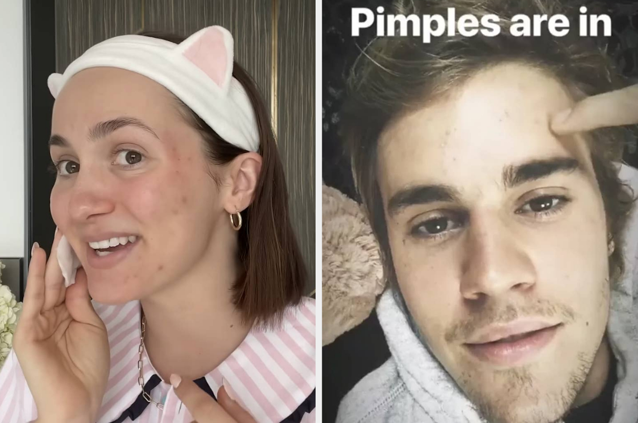 11-famous-people-who-have-been-totally-candid-about-struggling-with-acne,-and-it’s-so-refreshing-to-hear